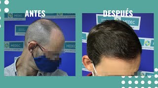 🙋‍‍ CASO REAL Injerto Capilar antes y después  3581 UFS  Resultados increíbles 👏‍‍ [upl. by Ennaitak]