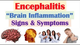 Encephalitis “Brain Inflammation” Signs and Symptoms amp Why They Occur [upl. by Eniwtna836]