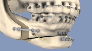 BSSO amp Osseous Genioplasty [upl. by Adnamra996]