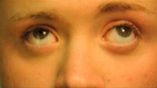 Nystagmus An Introduction [upl. by Rratsal]