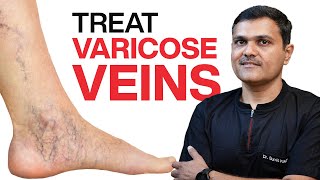 VASCULAR SURGEON Shares 11 Proven Ways to TREAT VARICOSE VEINS [upl. by Melville627]