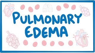 Pulmonary Edema  causes symptoms diagnosis treatment pathology [upl. by Atiek121]