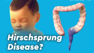 Hirschsprung Disease Colitis and Fecal Incontinence [upl. by Enilorac116]