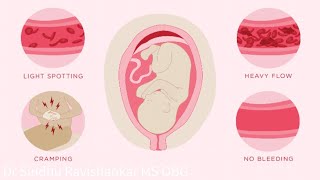 Bleeding in pregnancy  Implantation bleeding  Explained in Kannada  Dr Sindhu Ravishankar [upl. by Eissirc]