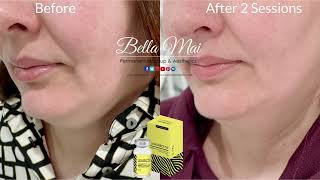 Lemon Bottle Fat Dissolver  CHIN  Before amp After 2 Treatments [upl. by Wawro]