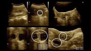 Bartholin cyst  Nabothian cyst  Renal cortical cyst  Amader hospital  Ultrasonography report [upl. by Millard]