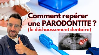 Apprendre à REPÉRER une PARODONTITE dentaire [upl. by Deutsch]