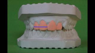 Orthodontic model analysis in Permanent Dentition [upl. by Eberto]