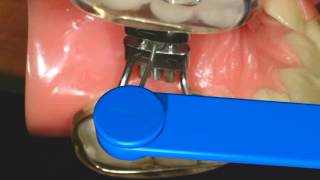 How to turn an RPE Rapid Palatal Expander  Nirenblatt Orthodontics [upl. by Florentia680]