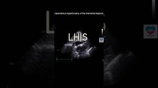 Lipomatous Hypertrophy of Interatrial Septum echocardiography 심장초음파 heart sonography tte [upl. by Gnanmas]