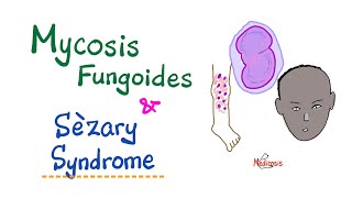 Mycosis Fungoides and Sèzary Syndrome  Hematology amp Oncology [upl. by Ahsiekahs]