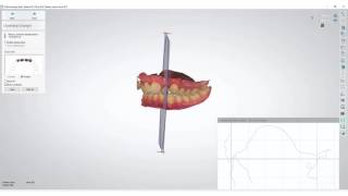 3Shape Ortho Analyzer  How to Measure Overjet and Overbite [upl. by Jelene]