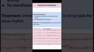 Ventricular Fibrillation [upl. by Aicarg]