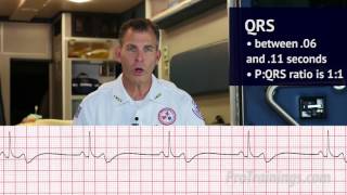 Bradycardia ECG Rhythm Interpretation [upl. by Nawor206]