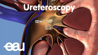 Removal of kidney stones URS [upl. by Nirihs555]