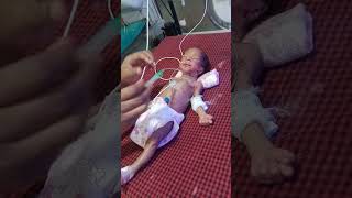 Feeding tube insertion procedure in newborn baby 🐥🍼😍medico youtubeshort viralvideo [upl. by Millar]