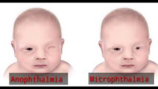 what is Anophthalmia  Microphthalmia  Terms means  Optometry solution [upl. by Auqeenahs]