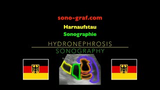 Sonographie  Harnaufstau [upl. by Ross585]