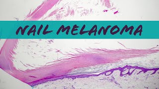 Subungual acral lentiginous melanoma in situ fingernail toenail nail melanoma pathology dermatology [upl. by Onibla934]