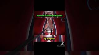 Removal of Thyroid Gland surgeryrecovery medicalstdents medical science surgeon [upl. by Neyut]