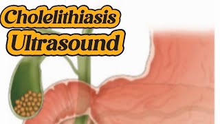 How to scan Gallstones  Cholelithiasis  calcified wall  cholecystitis  Sludge  Liver Ultrasound [upl. by Weylin]