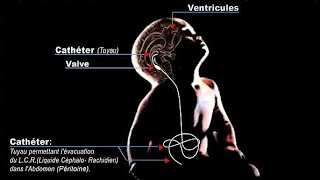 Lhydrocéphalie  partie 03 Traitement [upl. by Maunsell626]