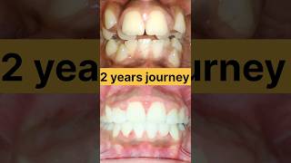 Braces removal process  braces removal by dentist ब्रेसिज़ कैसे हटाये जाते हैं  ब्रेसिज़ उपचार [upl. by Ventre]