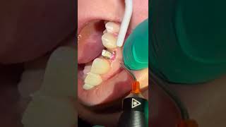 DentaLaze used for Gingivectomy Around an Implant [upl. by Yard]