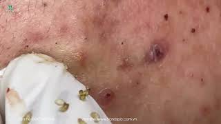 Big Cystic Acne Blackheads Extraction Blackheads amp Milia Whiteheads Removal Pimple Popping [upl. by Janet]