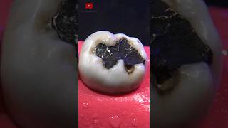 Restauración dental satisfying [upl. by Douglas]