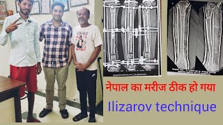 नेपाल का मरीज सही हो गया  infection in tibia bone fracture treatment with Ilizarov technique [upl. by Boland737]