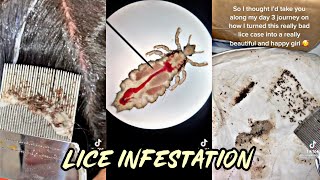 Lice Treatment TikTok Compilation 1 [upl. by Edlyn329]