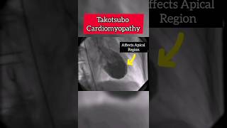 Myocardial Infarction due to Stress Takotsubo cardiomyopathy heart stress shorts shortsvideo [upl. by Rambort]