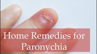 Top 6 Home Remedies for Paronychia and Best Home Treatment Methods [upl. by Remmus]