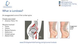 Lordosis Treatment A 3 Step Process [upl. by Ewold]