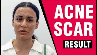 Testimonials Effective Treatments for Acne Scars and Pigmentation Sakhiya Skin Clinic Review [upl. by Strickler]