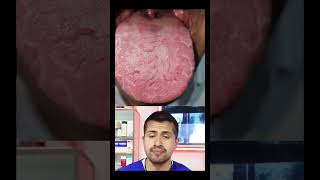 Lengua geográfica wow estudiantedemedicina fyoupage viral [upl. by Notnil]