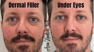 How to get rid of under eye hollows darkness Under eye restoration with dermal fillers [upl. by Wohlert]