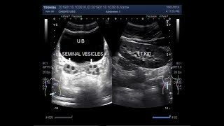 Ultrasound Video showing dilated and enlarged Seminal vesicles [upl. by Urina]