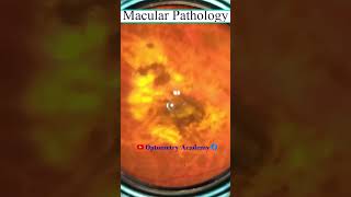 Macular Pathology  macular scar  Fundus Videography  Fundus Photography  Short Video 169 viral [upl. by Pfaff]