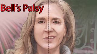 Bells Palsy  Facial Nerve palsy [upl. by Elayor]