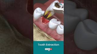 Tooth Extraction Procedure ↪ 3D Medical Animation Shorts Tooth ToothExtraction [upl. by Guimond325]