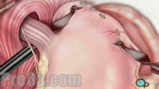 AntiReflux Laparoscopy Surgery PreOp® Patient Education Medical video [upl. by Annibo]