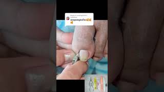 Fork naill treatment nail​​​ asmr fyp ear shorts viral wax [upl. by Sidnal]