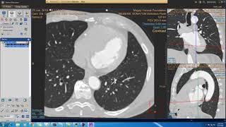 Philips portal CT Viewer amp cardiac CT viewer introduction 50 minutes [upl. by Jochebed766]