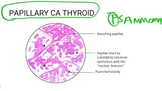 psammoma body  inicet neet pg  ARBORVITAENXT [upl. by Eocsor144]