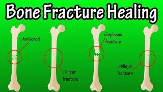 How Does A Bone Break Heal  Bone Fracture Healing Process [upl. by Sosthenna589]