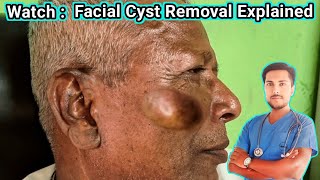 How to Remove a Sebaceous Cyst Safely Full Procedure Causes amp Treatment Options [upl. by Denison]