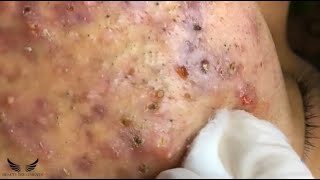 Blackhead Whitehead Removal  Cystic Acne Treatment  Elderly Pimple Popping  Facial Acne Spa 082 [upl. by Hennahane]