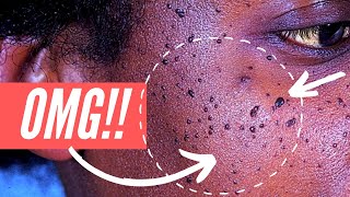 Why am I getting so many moles on my FACE Dermatosis Papulosa Nigra explained [upl. by Nea]